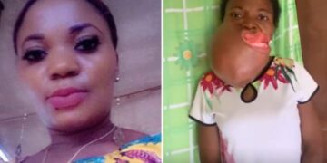 Nigerian Woman Diagnosed With Rare Oral Cancer Seeks ₦7m for Urgent Surgery