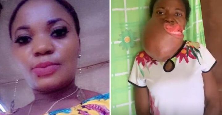 Nigerian Woman Diagnosed With Rare Oral Cancer Seeks ₦7m for Urgent Surgery