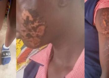 Police arrest Anambra woman for burning teenage domestic worker with hot iron