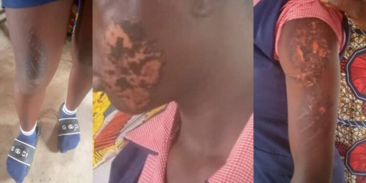 Police arrest Anambra woman for burning teenage domestic worker with hot iron